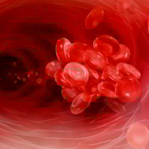 Post-thrombotic Syndrome - Blood Clots