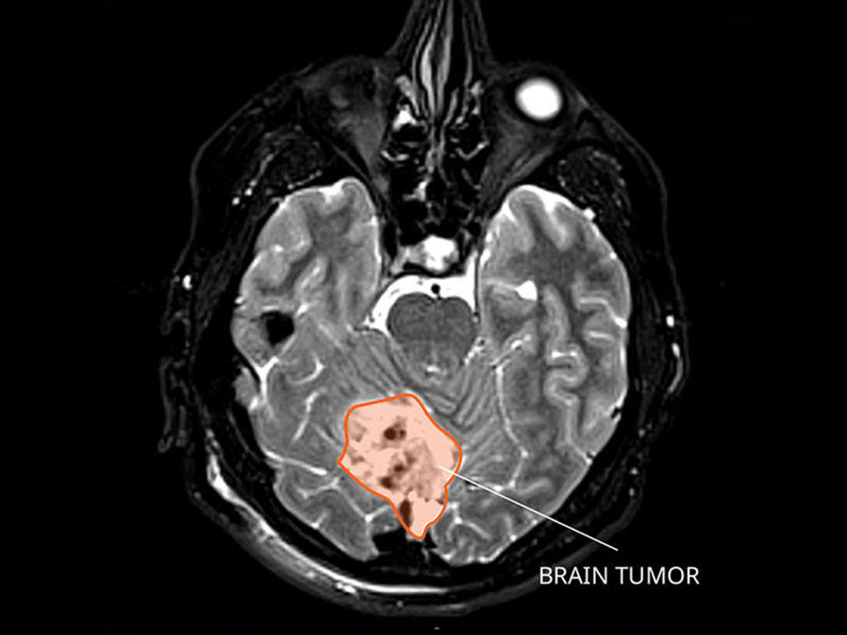مدولوبلاستوما: تشخیص و درمان - NCI